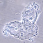 Clue cells (vaginal epithelial cells studded with coccoid bacteria)