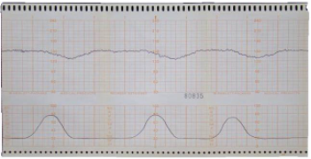 Representation of an electronic fetal monitor tracing showing regular uterine contractions every three minutes, accompanied by repetetive late decelerations.