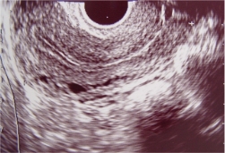 Ultrasound scan of uterus